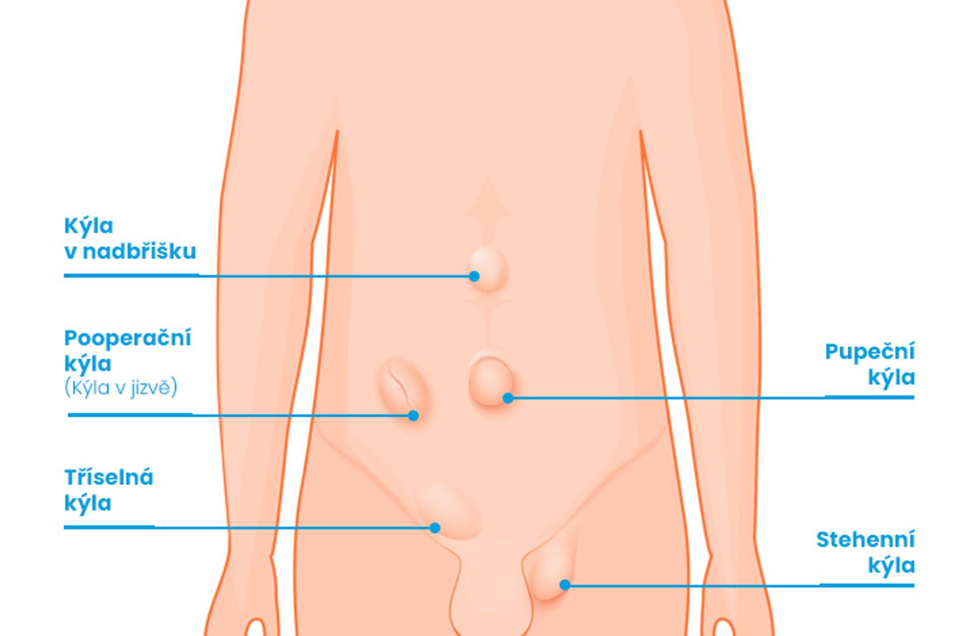 Infografika ISCARE - typy kýly Infografika ISCARE - typy kýly